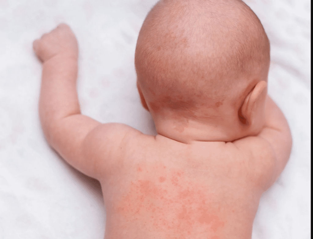 The Challenges of Parenting a Child With Eczema