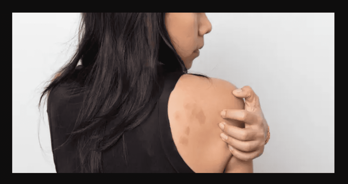 Women With Eczema